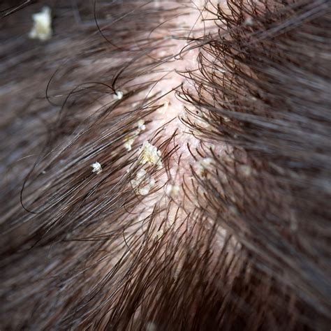 seborrhea scalp